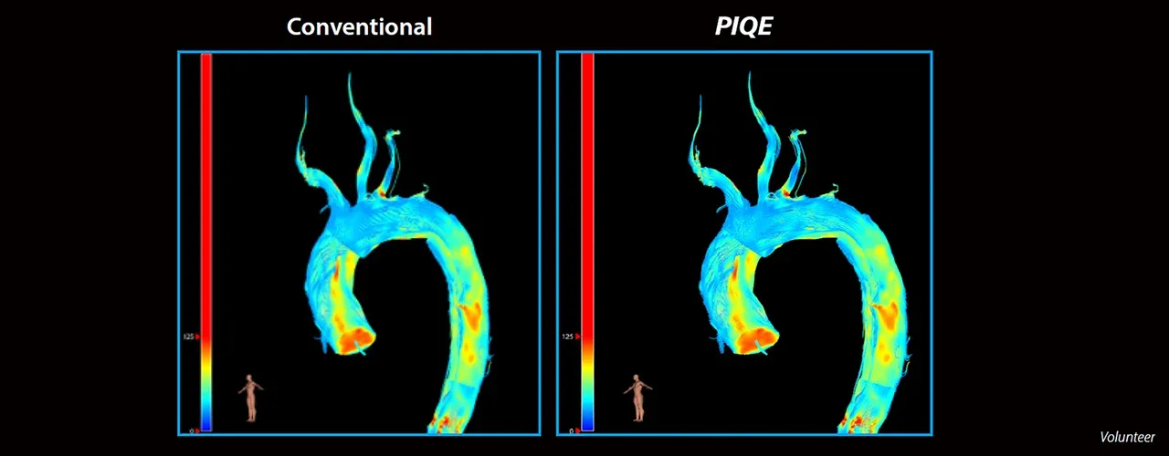 4D Flow: fluxul sanguin în arcul aortic, reconstrucție convențională comparativ cu PIQE