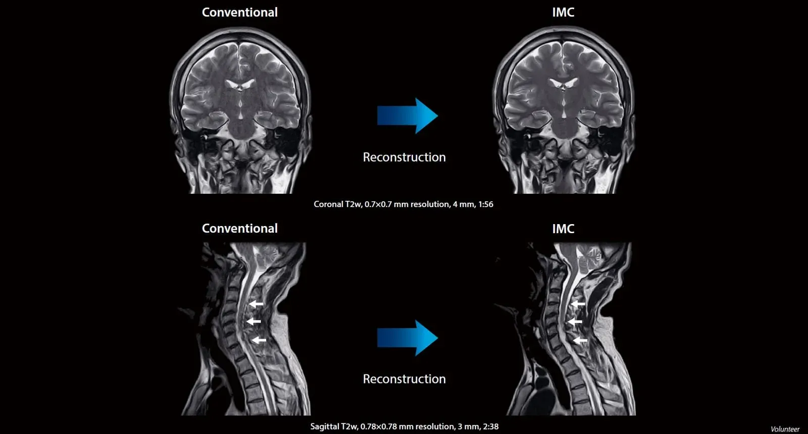 IMC: creier (T2 coronal) și coloană cervicală (T2 sagital), reconstrucție convențională comparativ cu IMC