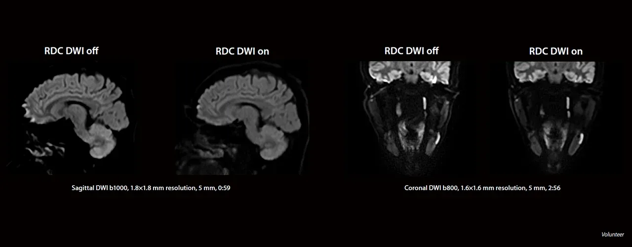 Fără și cu RDC DWI: DWI sagital al creierului și DWI coronal