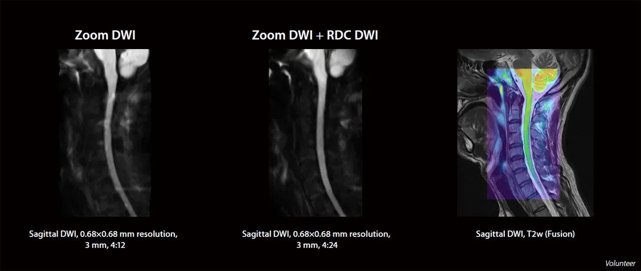 Zoom DWI și Zoom DWI + RDC DWI: măduva spinării la nivel cervical, DWI sagital și fuziune cu T2