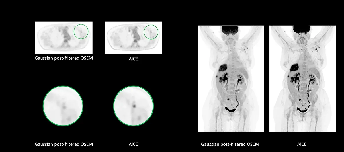 AiCE pentru PET: OSEM cu filtrare gaussiană comparativ cu AiCE, PET cu 18F-FDG
