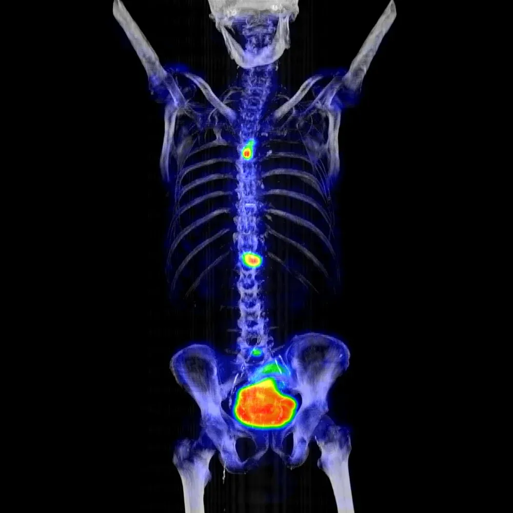 SPECT osos cu 99mTc-MDP: captare la nivelul sternului, claviculei drepte și vertebrei L1, sugestivă pentru metastaze (AnyScan TRIO)