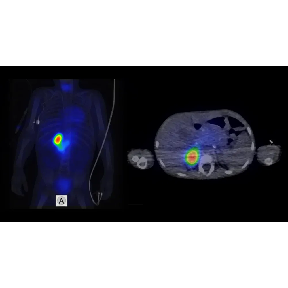 SPECT/CT cu 131I-MIBG și CT cu doză ultra-joasă: neuroblastom în glanda suprarenală dreaptă (AnyScan DUO SPECT/CT)