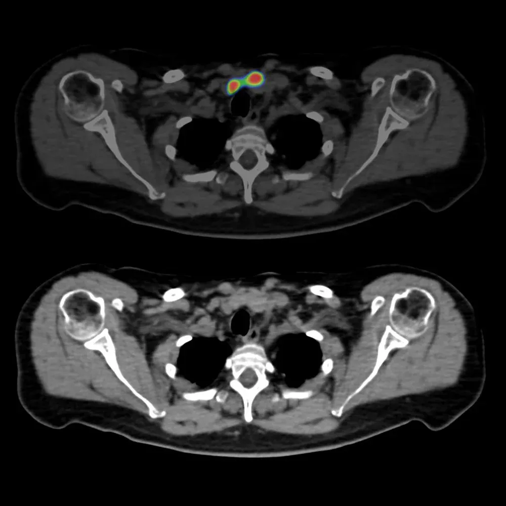 SPECT/CT cu 99mTc-MIBI: adenom paratiroidian (AnyScan DUO SPECT/CT)