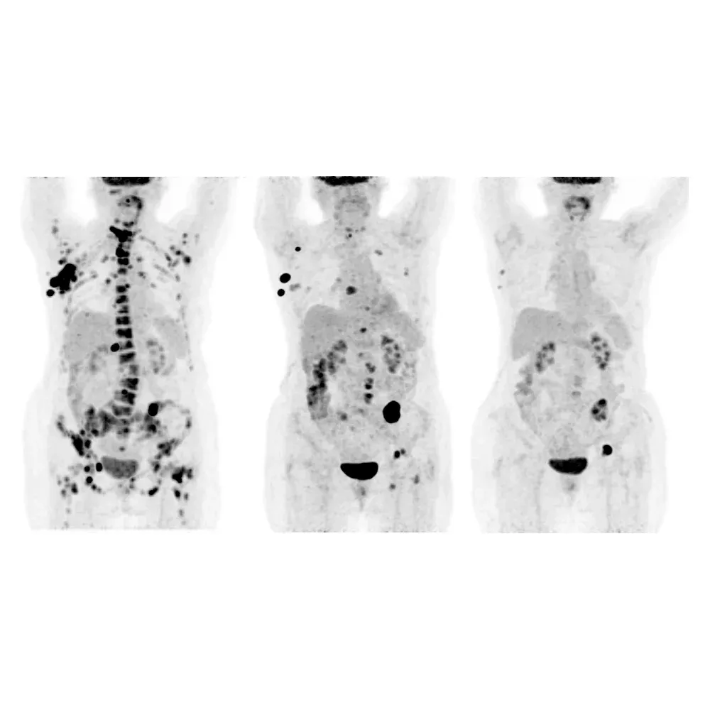 PET/CT cu 18F-FDG, monitorizare (follow-up): cancer mamar metastatic cu metastaze ganglionare și osoase (AnyScan PET/CT)