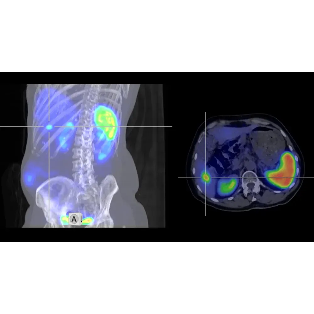 Scintigrafie a receptorilor de somatostatină cu 99mTc-Tectrotyd: metastază hepatică în segmentul VI (AnyScan DUO SPECT/CT)