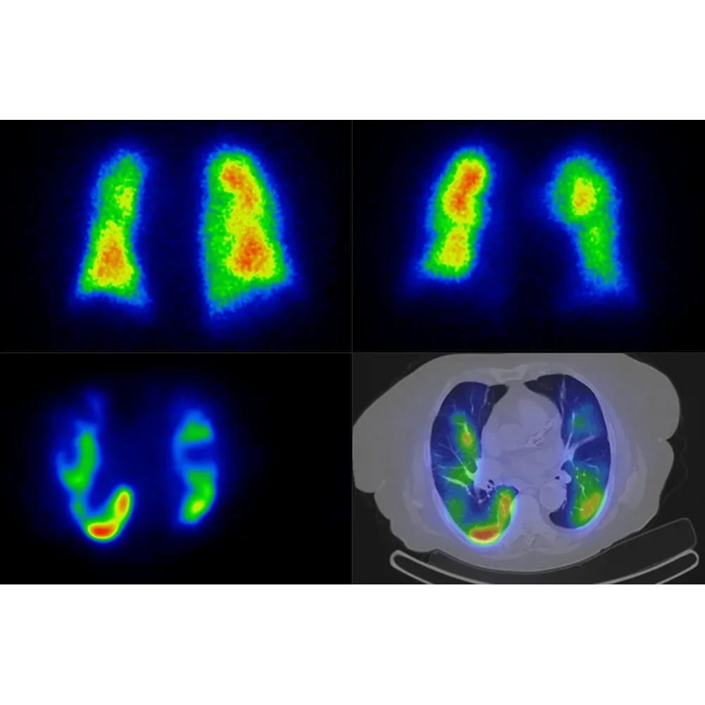 SPECT/CT V/Q (ventilație/perfuzie): embolie pulmonară în plămânul drept (AnyScan DUO SPECT/CT)