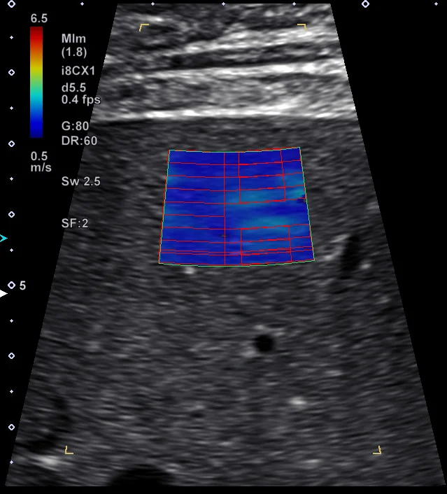 Elastografie Shear Wave cu Measurement Area Detection