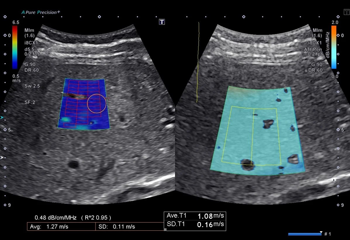 SWE și Attenuation Imaging achiziționate simultan