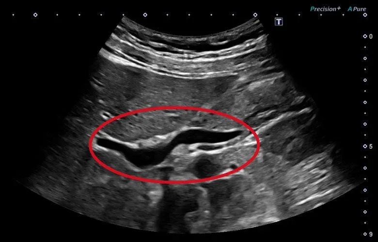 Canal coledoc — 3rd Harmonic Imaging