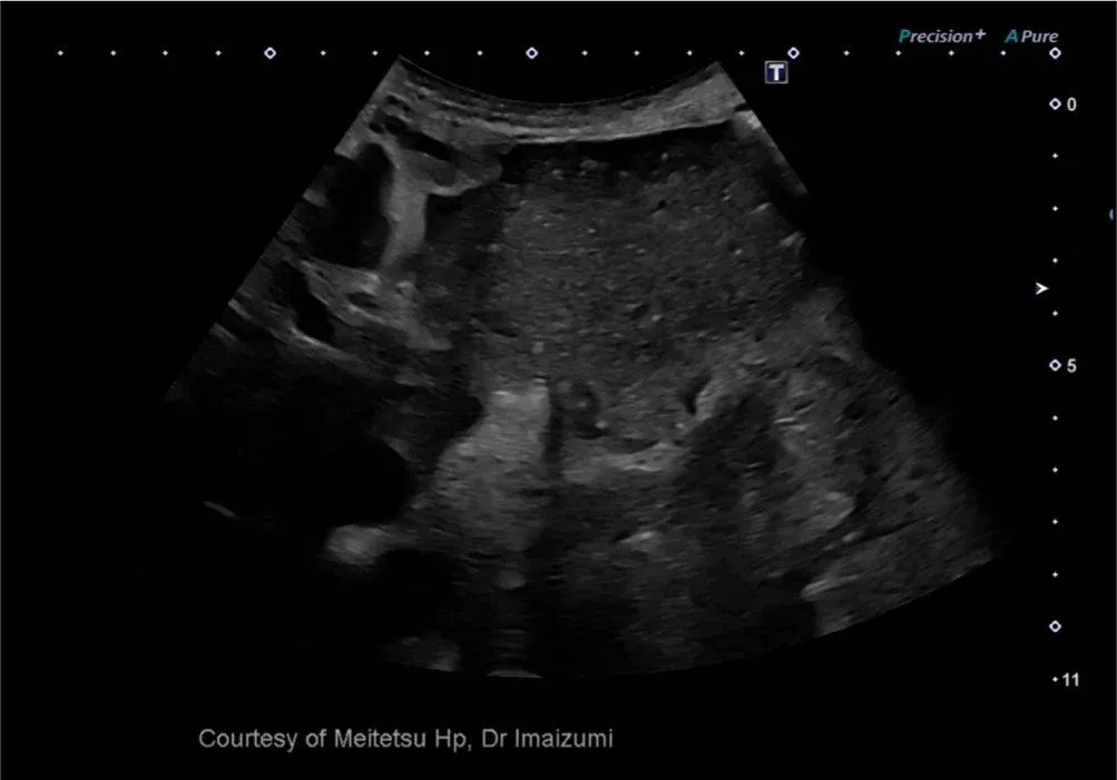 Neoplasm mucinos papilar intraductal (IPMN) — 3rd Harmonic Imaging