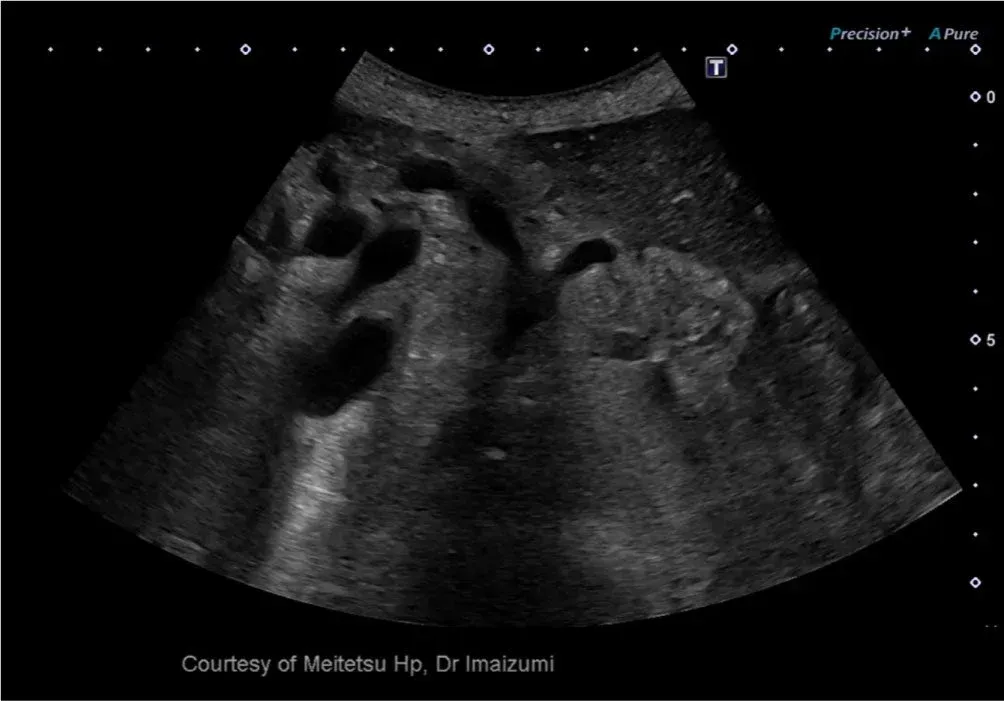 Neoplasm mucinos papilar intraductal (IPMN) — Convențional