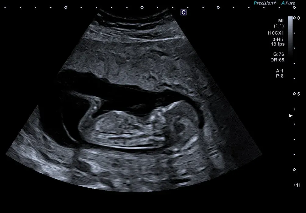 Obstetrică, trimestrul I — 3rd Harmonic Imaging