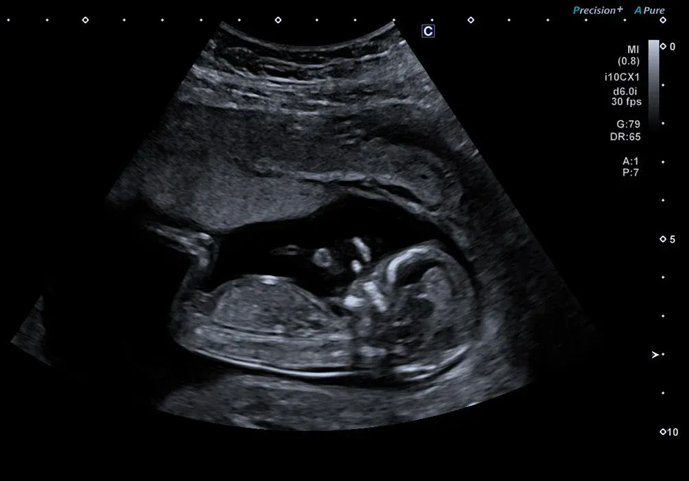 Obstetrică, trimestrul I — Convențional