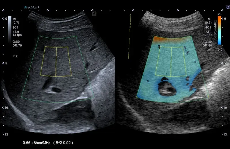 Attenuation Imaging (ATI)