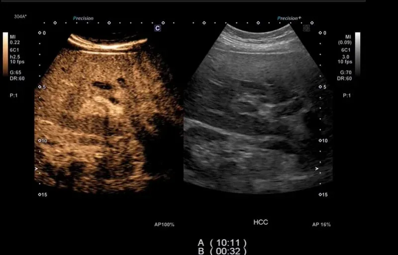 CHI (Contrast Harmonic Imaging)
