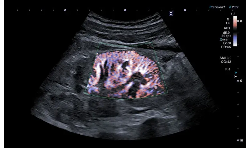Superb Micro-vascular Imaging (SMI)
