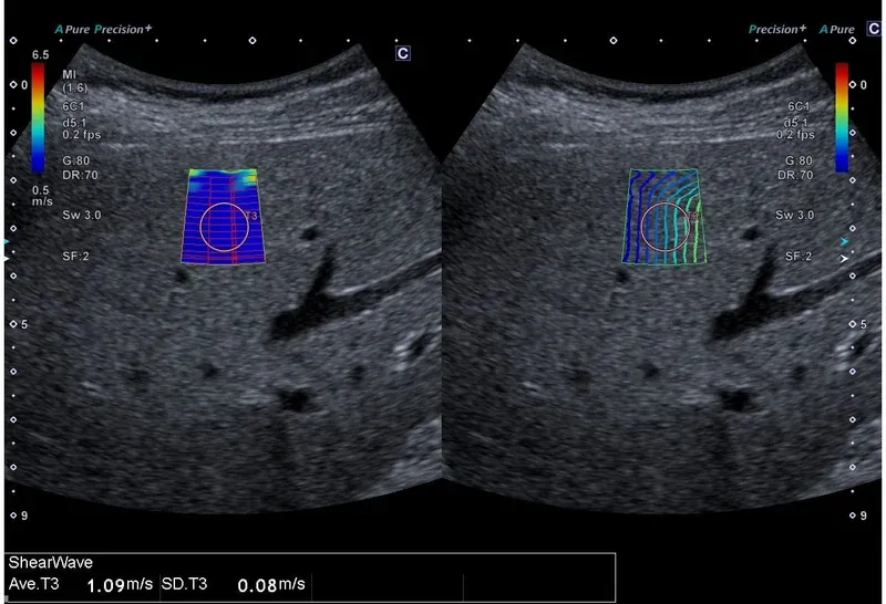 Shear Wave Elastography (SWE)