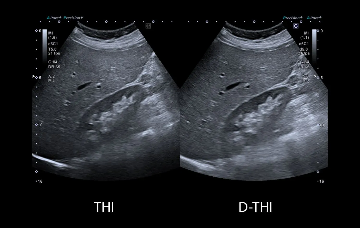 Ficat: THI (stânga) și D-THI (dreapta) — THI / D-THI