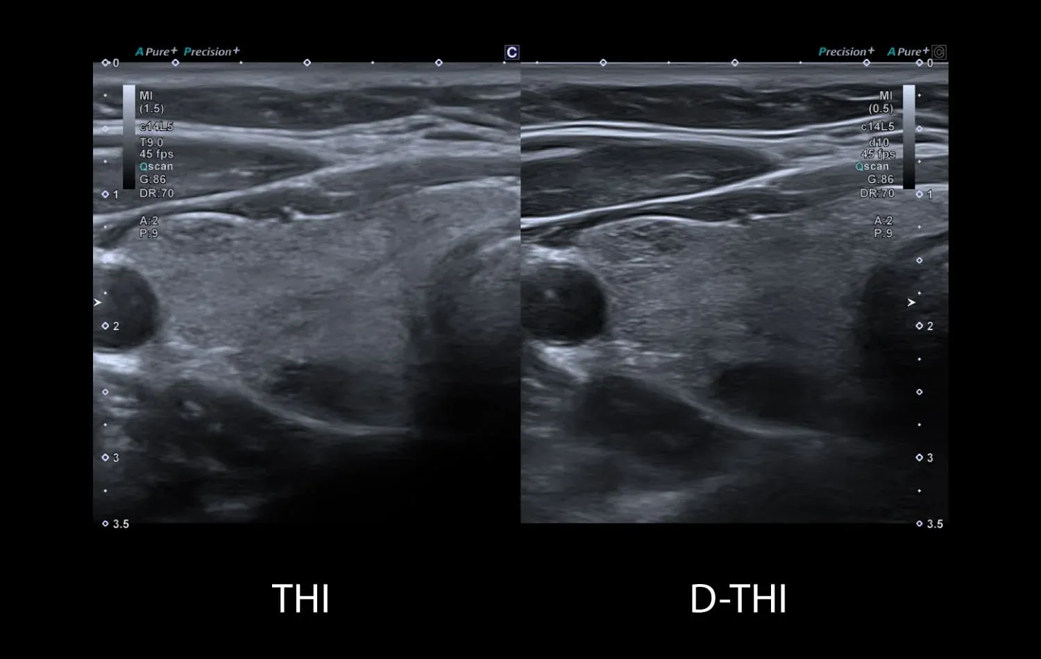 Tiroidă: THI (stânga) și D-THI (dreapta) — THI / D-THI