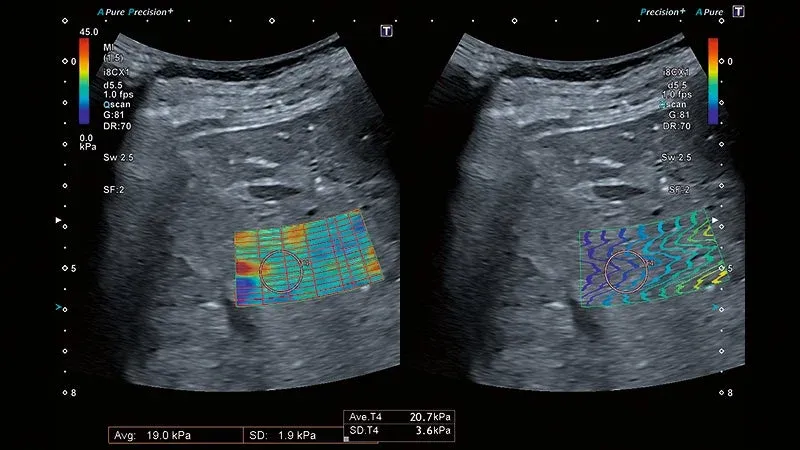 Fibroză: pe măsură ce fibroza progresează, parenchimul devine mai rigid; rigiditatea hepatică se măsoară prin elastografie shear wave (SWE).