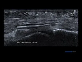 Corp străin localizat în tendonul flexor, vizualizat cu un transductor de 24 MHz – constatarea a schimbat conduita chirurgicală.