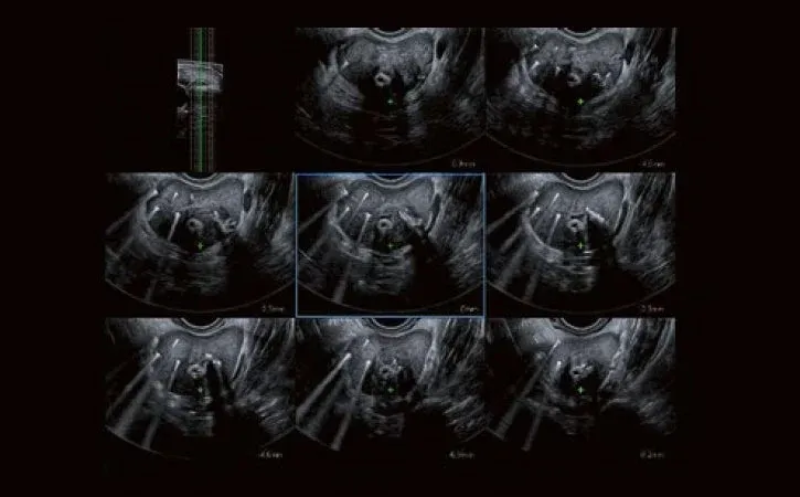 Smart 3D adaugă imagistica volumetrică la transductoarele convexe și liniare ale sistemului, în toate modurile, inclusiv în MR Smart Fusion.