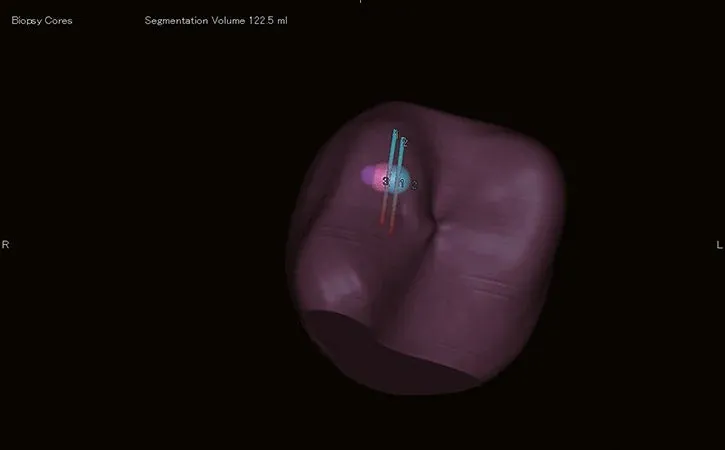 La finalul sesiunii, întreaga examinare este documentată în sistem, inclusiv o hartă 3D ușor de înțeles a carotelor bioptice din prostată.