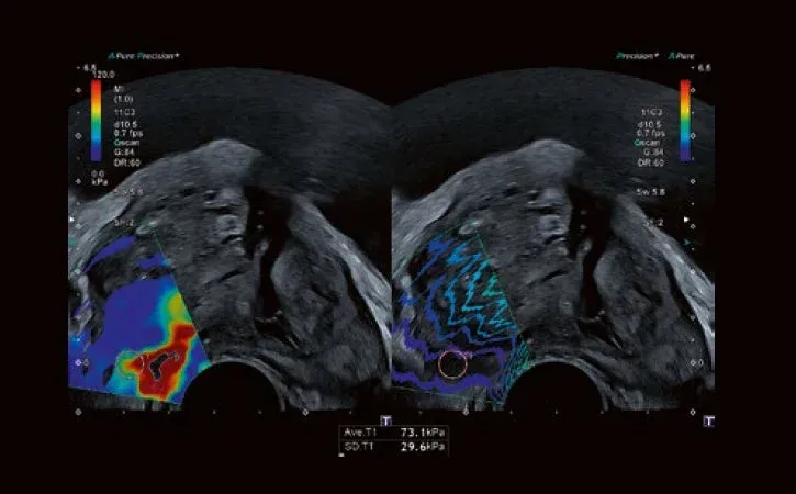 Setul complet de instrumente de elastografie shear wave (SWE) ajută la detectarea și cuantificarea modificărilor patologice cu mai multă încredere.