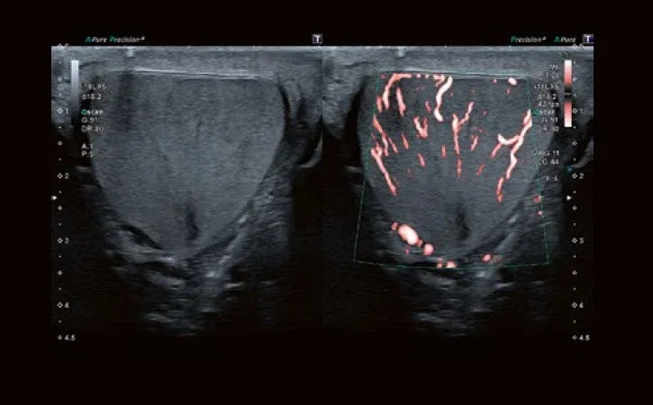 Cartografierea fluxului la rezoluție înaltă cu Superb Micro-vascular Imaging (SMI) – imagistică microvasculară – ajută la detectarea și caracterizarea leziunilor, în special la nivelul organelor de dimensiuni mici.